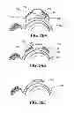 Fig. 40 - Ventricular cuff