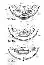 Fig. 41 - Ventricular cuff