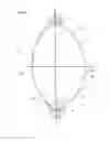 Fig. 03 - Inflatable intra ocular lens/lens retainer