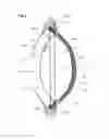 Fig. 05 - Inflatable intra ocular lens/lens retainer