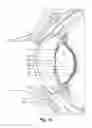 Fig. 11 - Inflatable intra ocular lens/lens retainer
