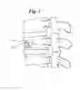 Fig. 02 - Expandable porous mesh bag device and methods of use for reduction, filling, fixation and supporting of bone