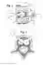 Fig. 03 - Expandable porous mesh bag device and methods of use for reduction, filling, fixation and supporting of bone
