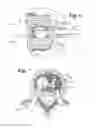 Fig. 05 - Expandable porous mesh bag device and methods of use for reduction, filling, fixation and supporting of bone