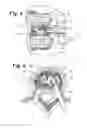 Fig. 06 - Expandable porous mesh bag device and methods of use for reduction, filling, fixation and supporting of bone