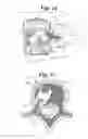 Fig. 09 - Expandable porous mesh bag device and methods of use for reduction, filling, fixation and supporting of bone