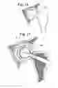 Fig. 10 - Expandable porous mesh bag device and methods of use for reduction, filling, fixation and supporting of bone