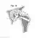 Fig. 11 - Expandable porous mesh bag device and methods of use for reduction, filling, fixation and supporting of bone