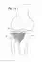 Fig. 12 - Expandable porous mesh bag device and methods of use for reduction, filling, fixation and supporting of bone