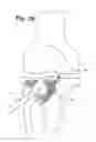 Fig. 13 - Expandable porous mesh bag device and methods of use for reduction, filling, fixation and supporting of bone