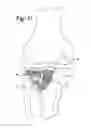 Fig. 14 - Expandable porous mesh bag device and methods of use for reduction, filling, fixation and supporting of bone
