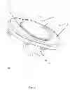 Fig. 10 - Artificial cervical and lumbar discs, disc plate insertion gun for performing sequential single plate intervertebral implantation enabling symmetric bi-disc plate alignment for interplate mobile core placement