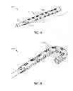 Fig. 03 - Memory material implant system and methods of use