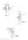 Fig. 03 - Extra-articular implantable mechanical energy absorbing systems