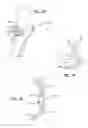 Fig. 13 - Extra-articular implantable mechanical energy absorbing systems