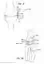 Fig. 17 - Extra-articular implantable mechanical energy absorbing systems