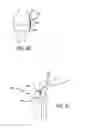 Fig. 26 - Extra-articular implantable mechanical energy absorbing systems