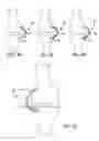 Fig. 33 - Extra-articular implantable mechanical energy absorbing systems