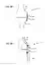 Fig. 37 - Extra-articular implantable mechanical energy absorbing systems