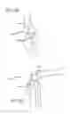 Fig. 40 - Extra-articular implantable mechanical energy absorbing systems
