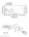 Fig. 47 - Extra-articular implantable mechanical energy absorbing systems