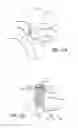Fig. 48 - Extra-articular implantable mechanical energy absorbing systems
