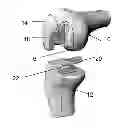 Fig. 01 - Implants for the treatment of osteoarthritis of the knee