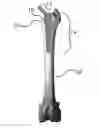 Fig. 01 - HIP STEM PROSTHESIS WITH A POROUS COLLAR TO ALLOW FOR BONE INGROWTH