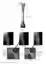 Fig. 03 - HIP STEM PROSTHESIS WITH A POROUS COLLAR TO ALLOW FOR BONE INGROWTH