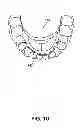 Fig. 04 - METHOD AND A SYSTEM USABLE IN CREATING A SUBSEQUENT DENTAL APPLIANCE