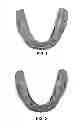Fig. 02 - Custom orthodontic appliance system and method