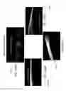 Fig. 63 - Conformable therapeutic shield for vision and pain