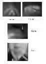 Fig. 20 - INTRA-ORAL LIGHT THERAPY APPARATUSES AND METHODS FOR THEIR USE
