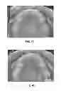Fig. 22 - INTRA-ORAL LIGHT THERAPY APPARATUSES AND METHODS FOR THEIR USE