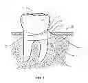 Fig. 02 - PERIODONTAL DISEASE DEVICES AND METHODS