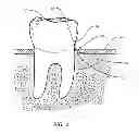 Fig. 03 - PERIODONTAL DISEASE DEVICES AND METHODS