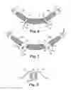 Fig. 04 - Implants, tools, and methods for treatment of pelvic conditions
