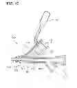 Fig. 45 - Catheter with imaging assembly with placement aid and related methods therefor