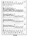 Fig. 49 - Methods and systems for determining an algorithm setting based on a difference signal