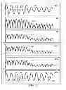 Fig. 49 - METHODS AND SYSTEMS FOR DETERMINING NOISE INFORMATION FROM A PHYSIOLOGICAL SIGNAL