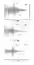 Fig. 43 - METHODS AND SYSTEMS FOR DETERMINING PHYSIOLOGICAL INFORMATION BASED ON THE SHAPE OF AUTOCORRELATION PEAKS