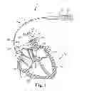 Fig. 02 - Methods and systems for recharging an implanted device by delivering a section of a charging device adjacent the implanted device within a body