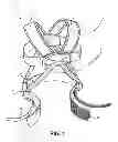 Fig. 02 - Posture and Lifting Orthotic