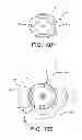 Fig. 09 - Insulin infusion set