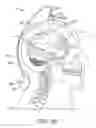 Fig. 03 - Apparatus, systems and methods for the treatment of neurological conditions