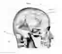 Fig. 05 - Apparatus, systems and methods for the treatment of neurological conditions