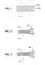 Fig. 02 - Bioabsorbable Spacers and Spacer Delivery Systems for Use in the Ear, Nose and Throat