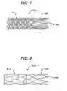 Fig. 05 - Bioabsorbable Spacers and Spacer Delivery Systems for Use in the Ear, Nose and Throat