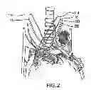 Fig. 03 - Methods and systems for treating acute heart failure by neuromodulation
