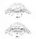 Fig. 05 - Methods and systems for performing a posterior capsulotomy and for laser eye surgery with a penetrated cornea